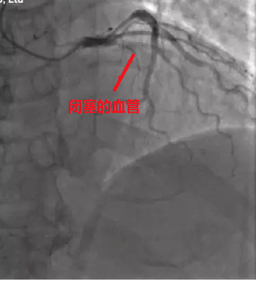 放入支架后的血管