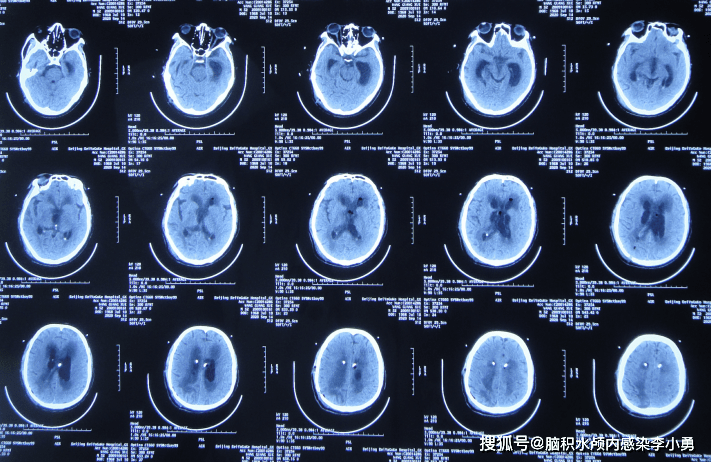 脑脓肿术后脑积水颅内感染致意识不清脑室粘连,7个月3家医院7次治疗仍