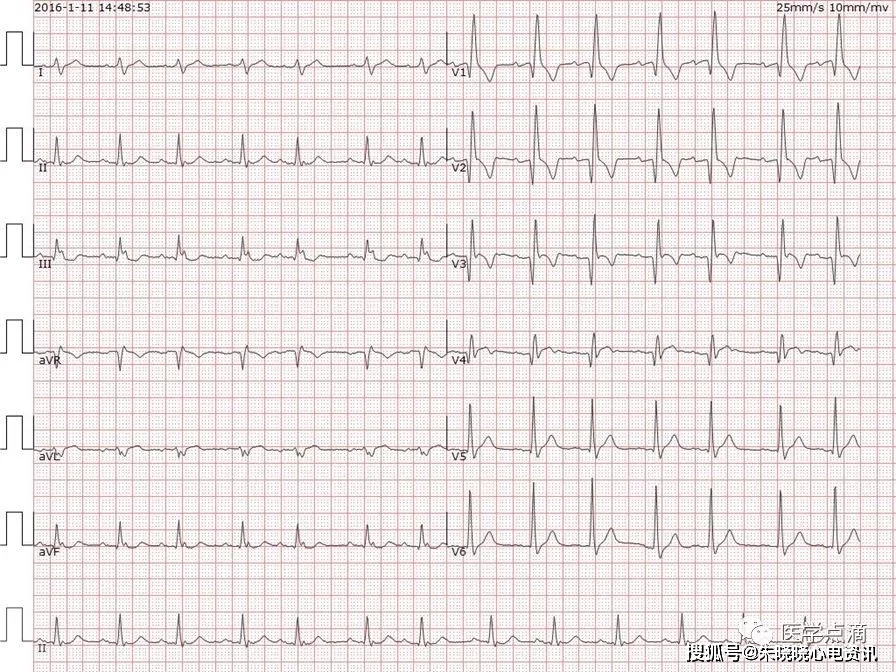 心电图"零"基础入门,干货满满!