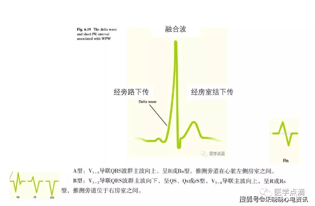 预激综合征(δ波,p-r间期bian变短,qrs波增宽) (与左束支传导阻滞