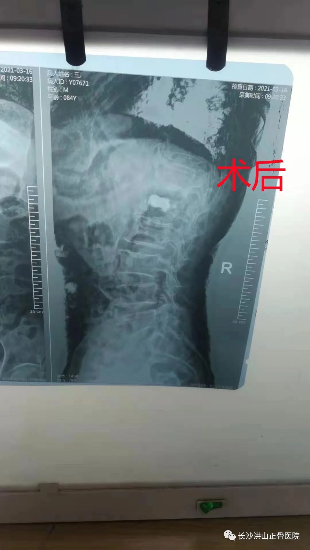 患者王嗲术后腰椎x光片影像