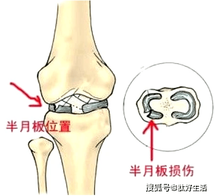 关于半月板的十问十答!