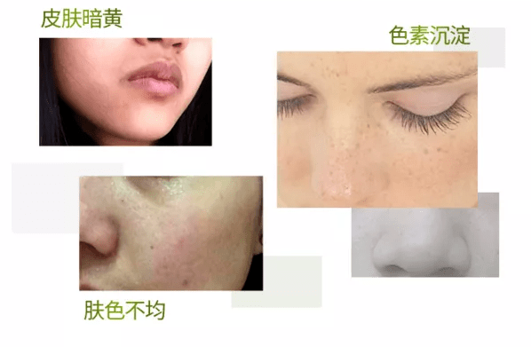 熊果苷 美白淡斑,去暗沉,淡化顽固色斑褐斑.