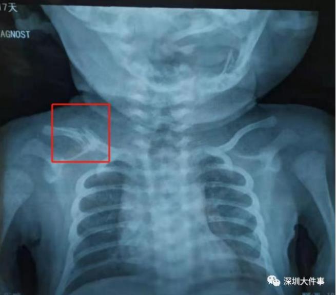 深圳一家医院同日出生两婴儿都锁骨骨折家长索赔万元遭拒