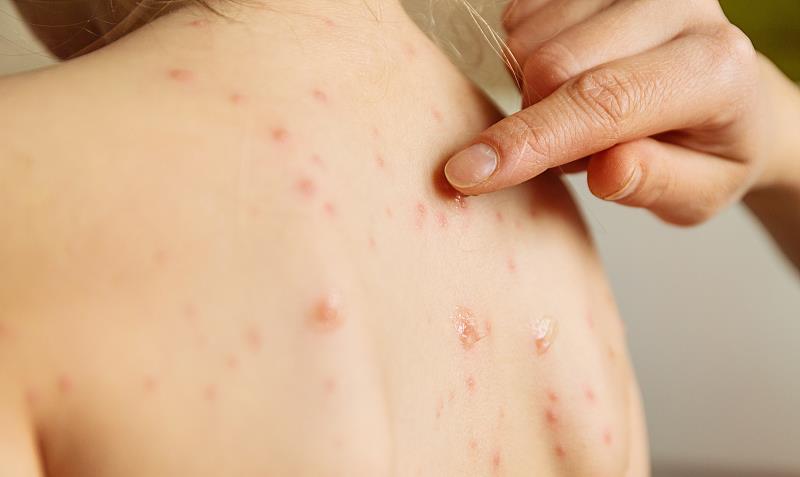 原创单纯疱疹病毒感染,常发病在皮肤表面,有传染性,有症状便就医