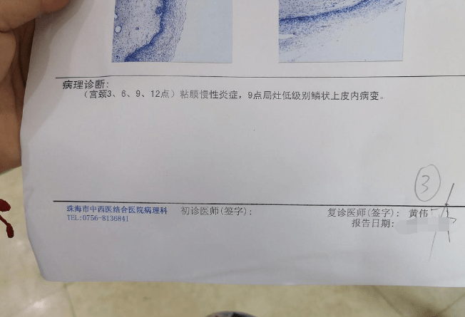 29岁女子感染hpv,活检提示宫颈已癌变,原来6年前就有提示了