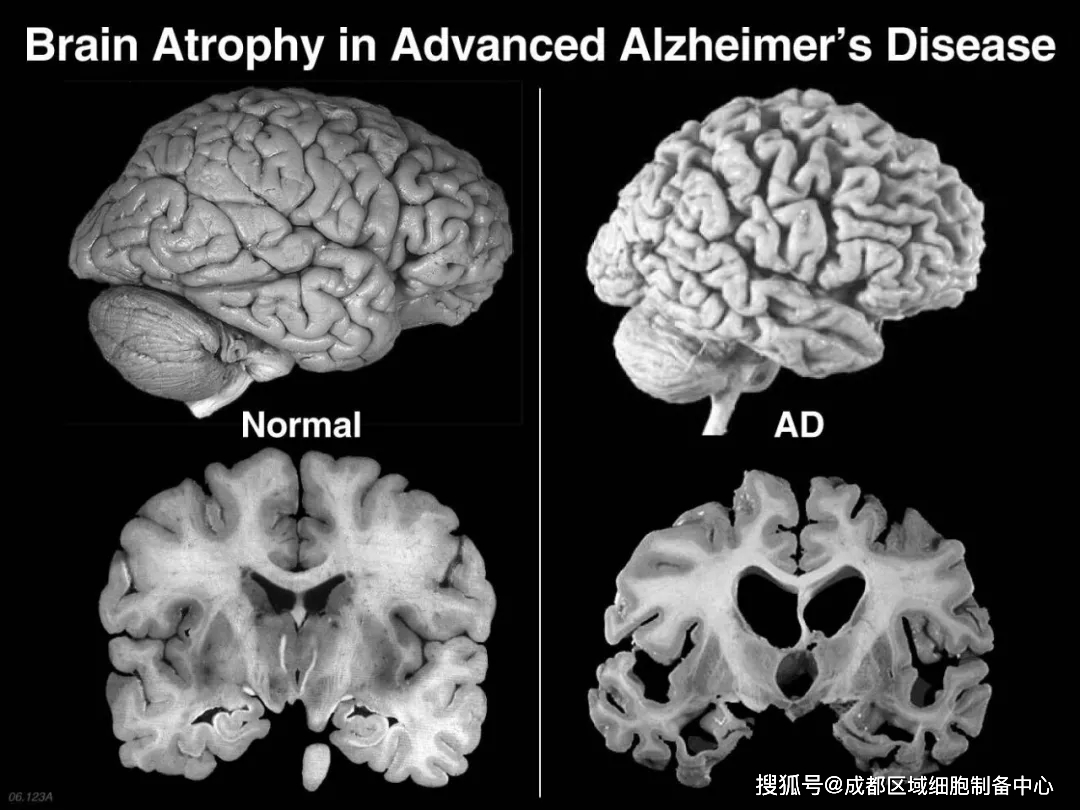 大脑受损是阿尔兹海默病发生的原因