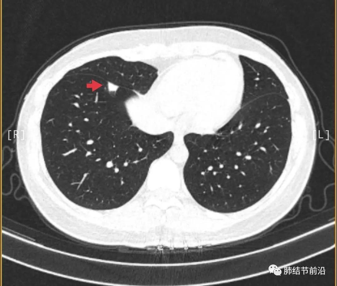 肺结节读片(21):鉴别11mm的实性结节良恶性的技巧_肺部
