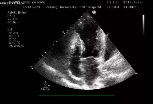 明显心包积液第10天收缩功能变差左室扩大,血栓形成,第5天该患者心梗