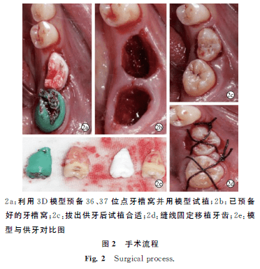 05);植入人工牙槽窝的移植牙牙根吸收接近一半,与早期牙槽窝相比无