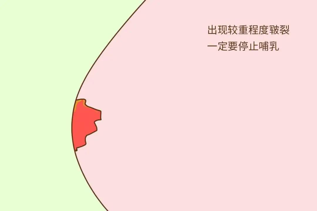 产后奶水少,乳房变形……这些问题你有吗?