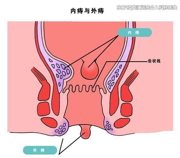 痔疮外痔肉球怎么消除