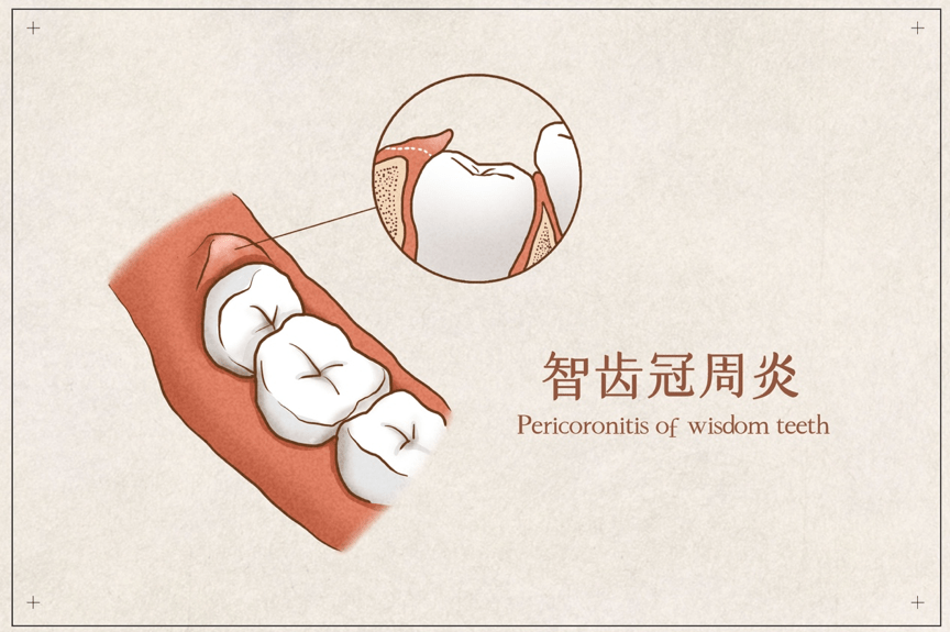 有的智齿在生长的过程中,直接倒在了邻牙上.