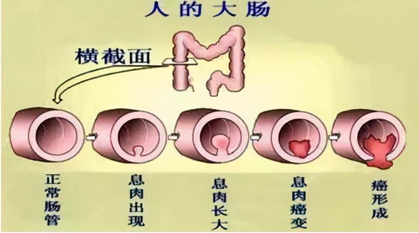 原创17岁女孩结肠长上万个息肉肠息肉到肠癌究竟还差多少距离