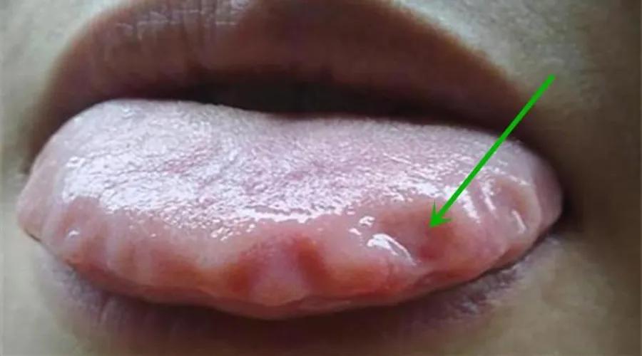 原创舌诊浅析:舌头有齿痕,舌面裂纹以及舌尖红点