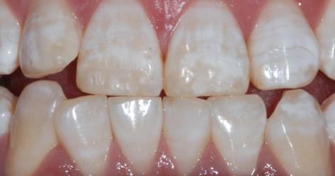 儿童获取的氟剂可以增加牙釉质强度,从而使牙齿不容易被酸腐蚀而蛀掉.