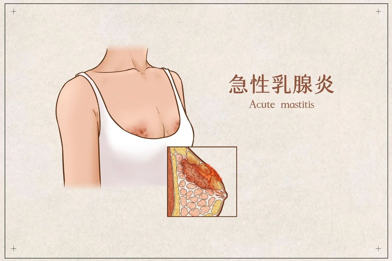 【贴心医生】乳房有肿块,就是乳腺癌吗?