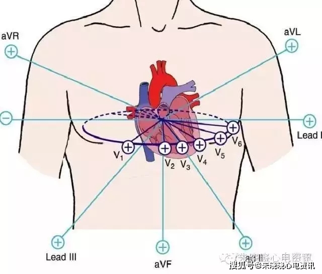 v5r导联,其部位相当于右胸的v3,v4,v5,也可加做v7,v8,v9导联,其位 