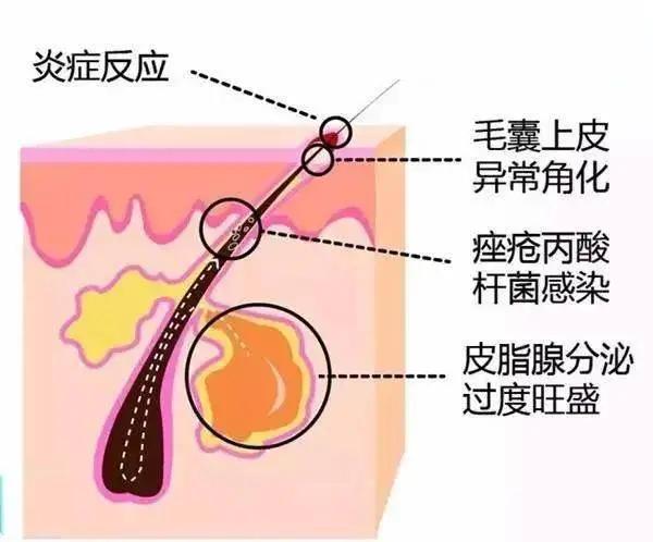 痘痘的发病原因 部分痤疮患者确实可以在青春期后得到自愈的现象,但一