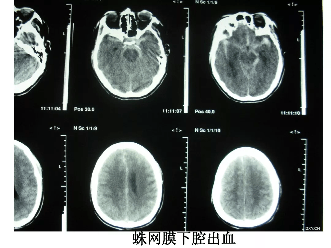 影像总结:头颅ct基本知识与常见病变