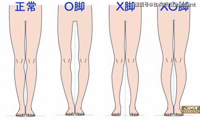 jmt日本医疗-孩子的o型腿和x型腿,有时需要治疗和观察