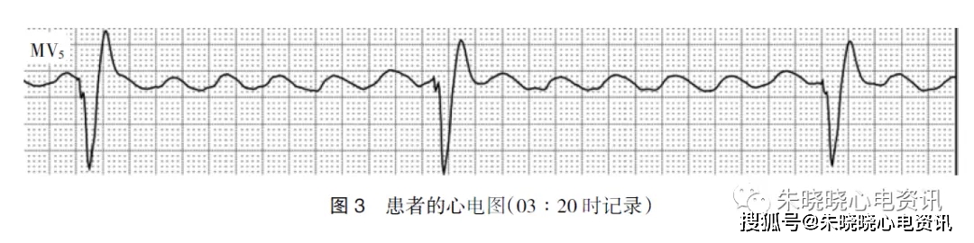 房室传导阻滞,加速的室性逸搏心律,一过性心室电分离现象,心室扑动及