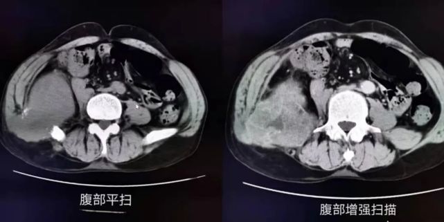 中年男性因 腰痛2 月,发现右侧腰部包块当时大小约 2.5*2.