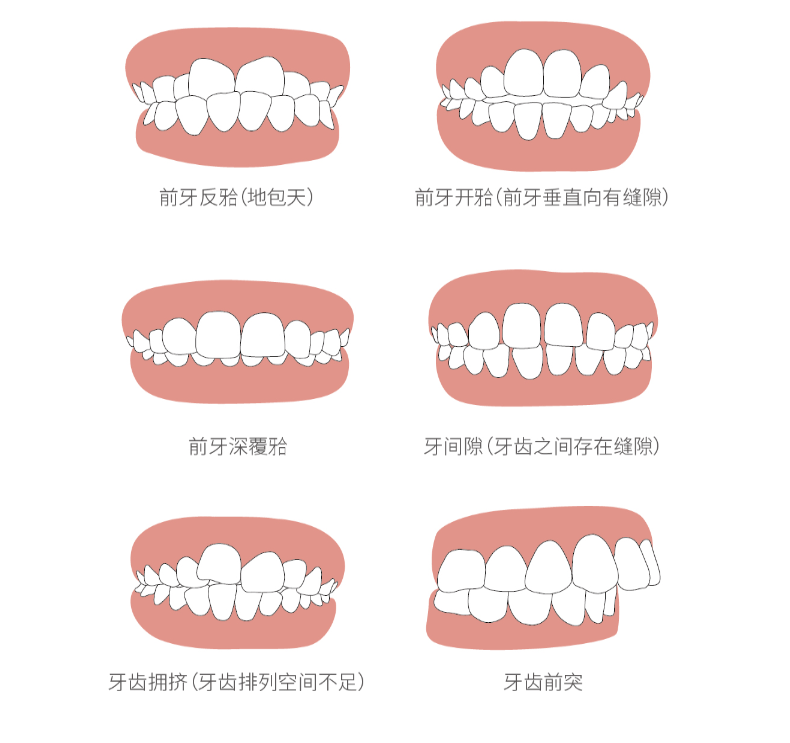 前切牙咬不住 前牙深覆合:上牙包住下牙 牙间隙:牙齿之间存在缝隙