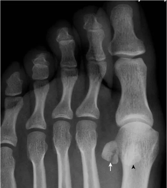 足部x线的正常表现与常见变异及病变建议收藏