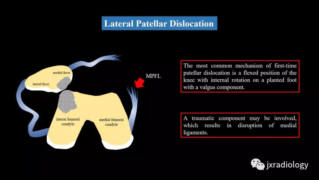 胫骨结节的偏侧性(lateralization of the tibial tuberosity)