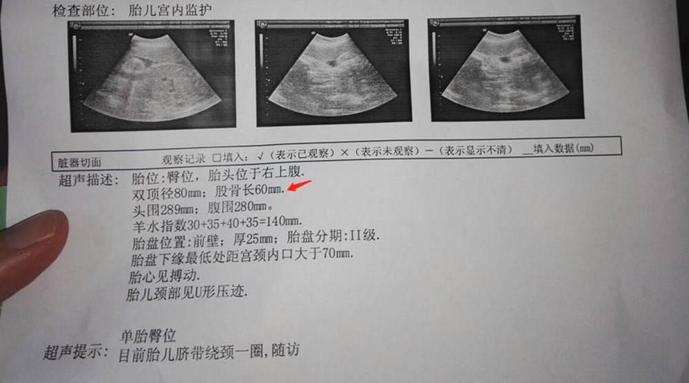 产检时胎儿股骨短,意味着孩子是矮个子吗？背后原因很复杂
