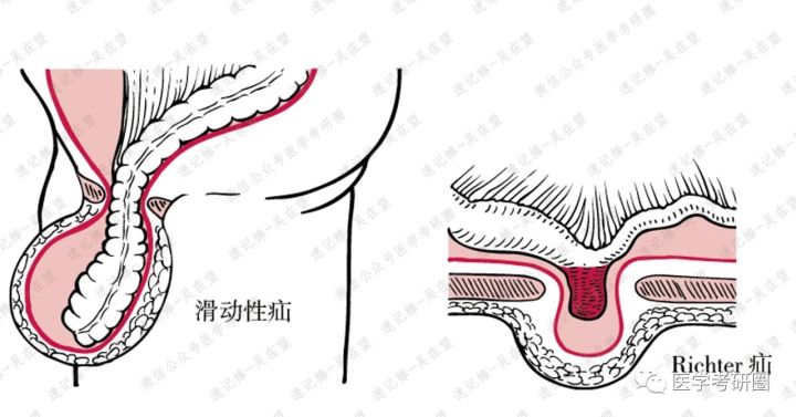 滑动性疝和richter疝的区别不同联系