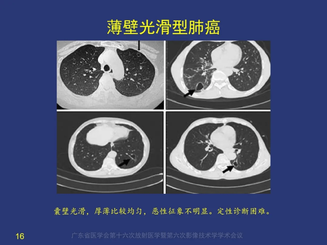 囊腔性肺癌如何诊断空洞性肺癌