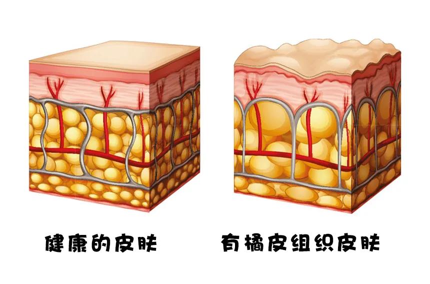 干货满满橘皮组织有救了大腿变得又细又滑