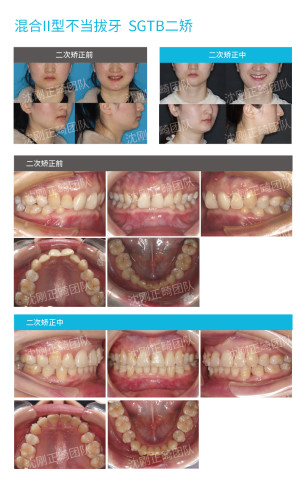下图为沈刚正畸团队为某混i病例使用sgtb进行二矫时口内口外对比照