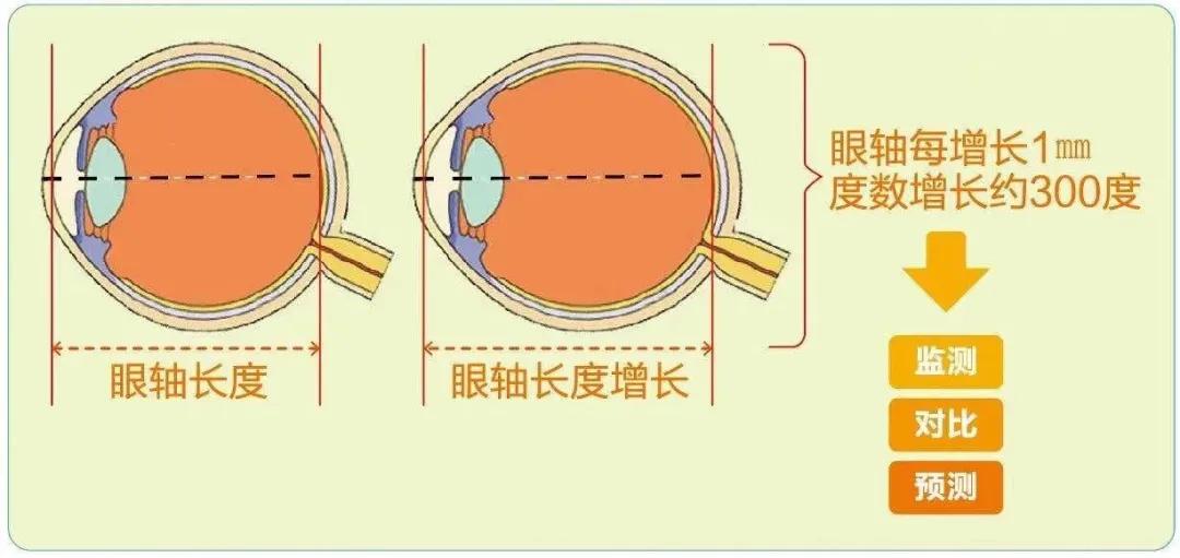 另一方面,通过 建立完善屈光发育档案,每3~6个月前往医院进行视光