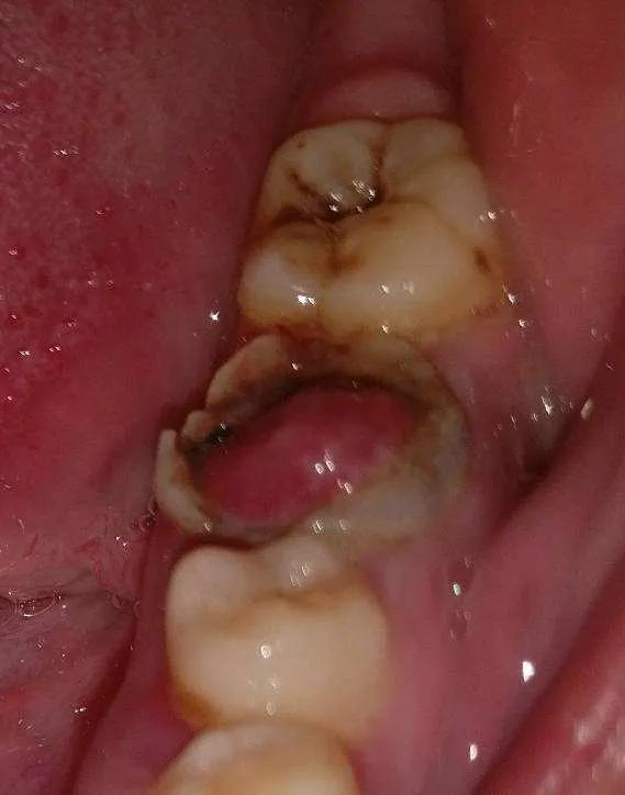当查及患牙深洞有息肉时,临床上还要与牙龈息肉和牙周膜息肉相鉴别.