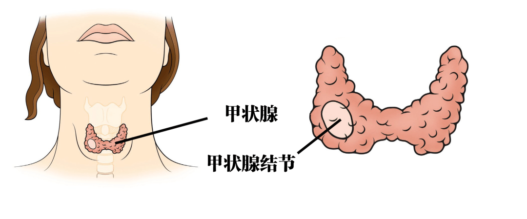 甲状腺结节高发,会不会变成癌?海鲜,碘盐能不能吃?2种