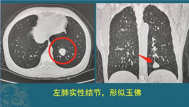 肺上有结节,5个细节揭示有没有癌细胞,医生叫你看ct片