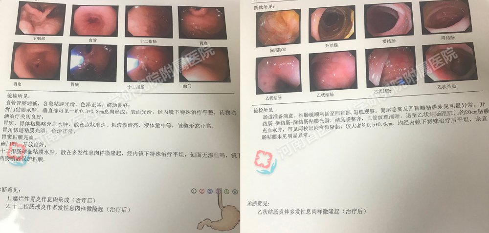 患者镜下结果显示为十二指肠球炎伴多发性息肉样隆起,乙状结肠炎伴