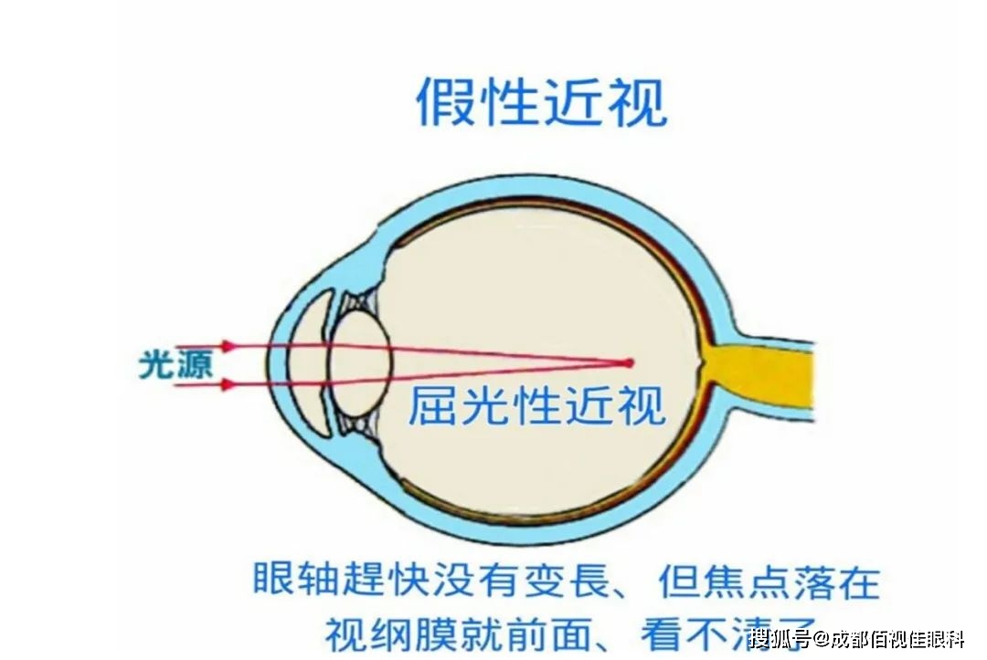 如听之任之,发展为高度近视的可能性增大,由此带来的眼底并发症,及