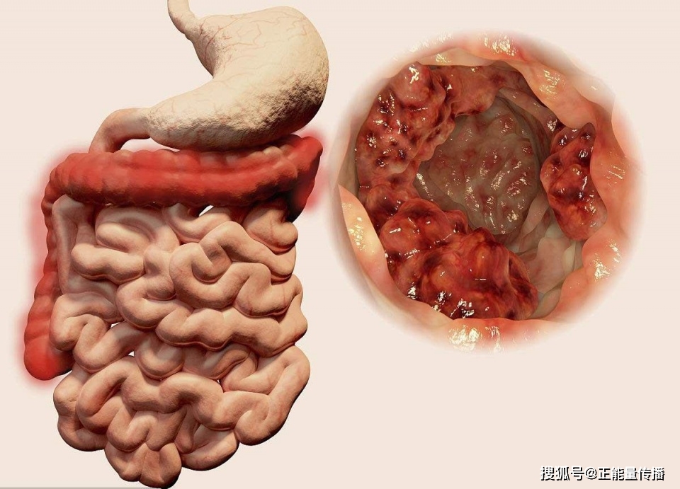 肠癌无预兆,身体出现5"变化",或是大肠癌信号,不可忽视