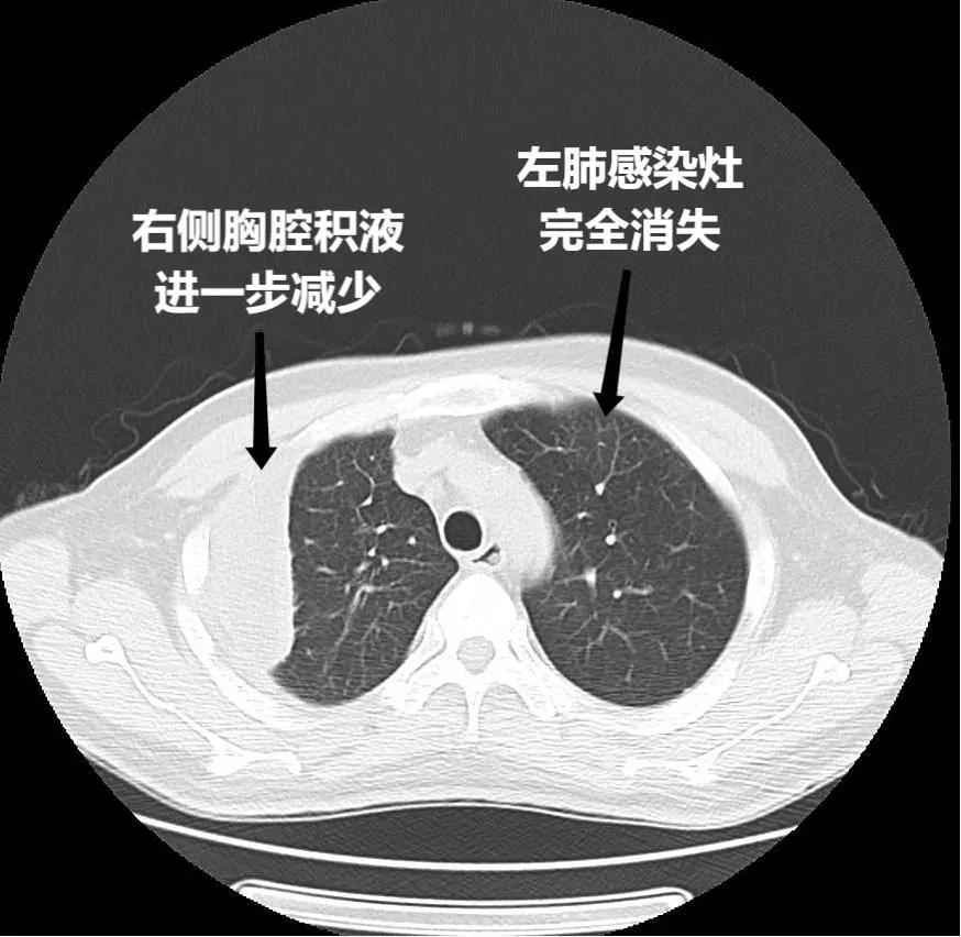 6月3日出院前复查胸部ct可见积液减少,感染灶基本消失.
