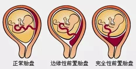 胎盘完全覆盖子宫下段及颈内口被称为完全性前置胎盘, 是前置胎盘最