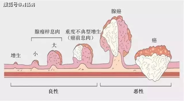 原创长期便秘喝泻药,结果悲剧了——肠子不但黑了,还有早癌