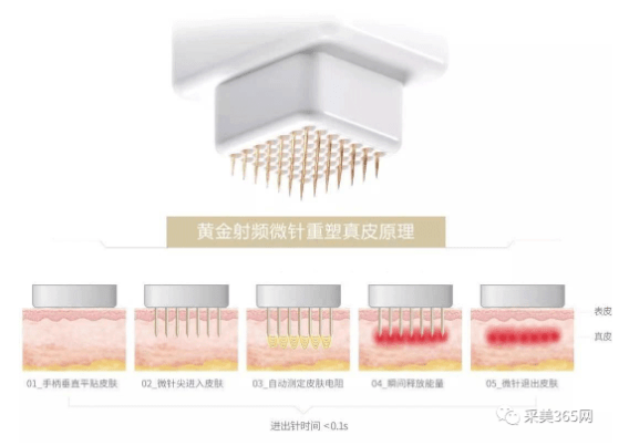 原创医美机构开业推荐韩国jeisysintracel5d专业做黄金射频微针项目的