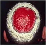 其上头发参差不齐,易于拔出;脓癣初起为成群的红色毛囊丘疹,逐渐融合