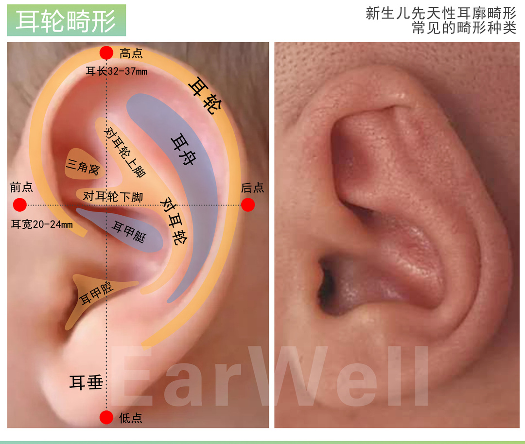 耳轮畸形——耳轮粘连,扁平或消失;耳轮缘不卷曲.