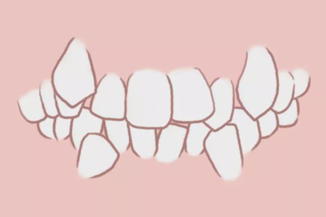 主要有两个方面: 牙齿不整齐 错颌畸形又称牙齿不齐,是指儿童生长发育