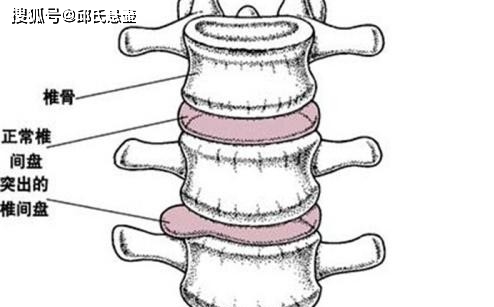 腰椎间盘突出的治疗方法!邱氏悬壶
